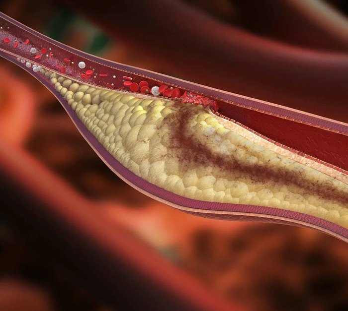 Холестериновые бляшки