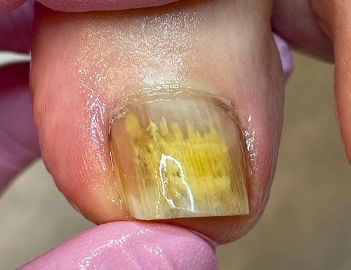 Прогрессирование грибка ногтя