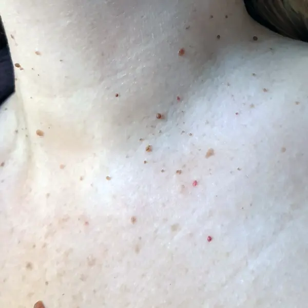 Папилломы на груди