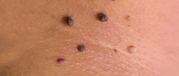 Папилломы на коже