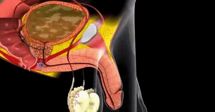 График результатов Проктозит