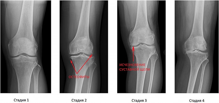 Артроз коленного сустава