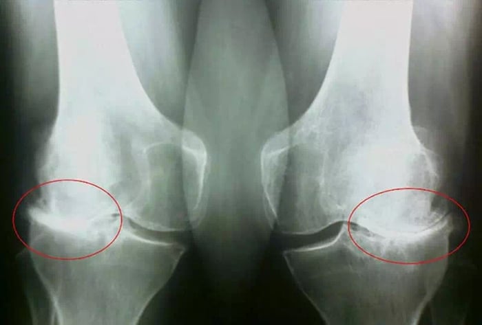 Диагноз артроз